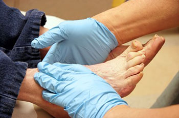 diabetic limb salvage
