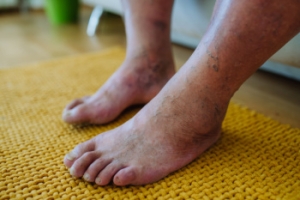 The Necessity of Proper Foot Care for Diabetic Patients