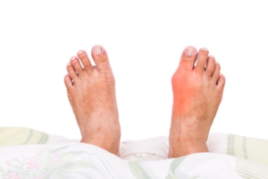 Can Relief Be Found From Bunions?