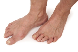 Early Signs of Rheumatoid Arthritis in the Feet