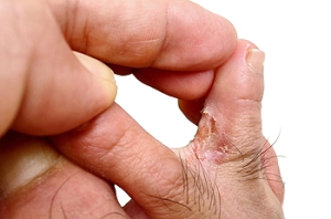 Athlete&#039;s Foot Is a Common but Treatable Skin Infection