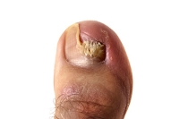When Toenail Fungus Becomes More Than Cosmetic