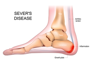 Understanding Sever&#039;s Disease