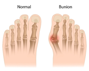 Adolescent Bunions and How They Are Treated