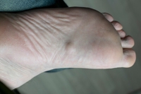 A Foot Condition Called Plantar Fibroma